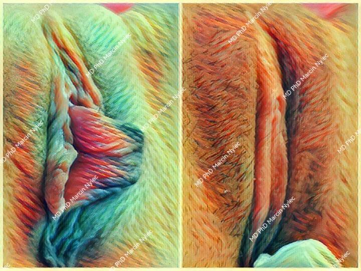 Labioplasty photos - before and after results.