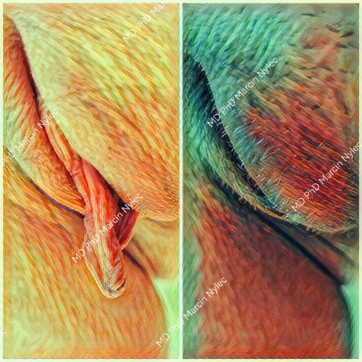 Labioplasty results - before and after aesthetic gynecology surgery.
