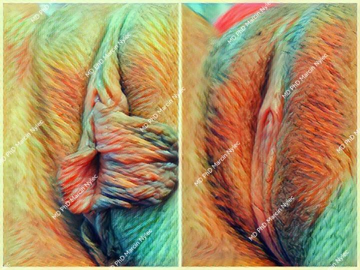 Labioplasty effects - showing before and after surgery.