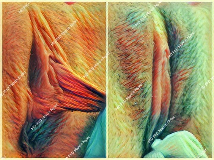 Labioplasty best results - detailed before & after.