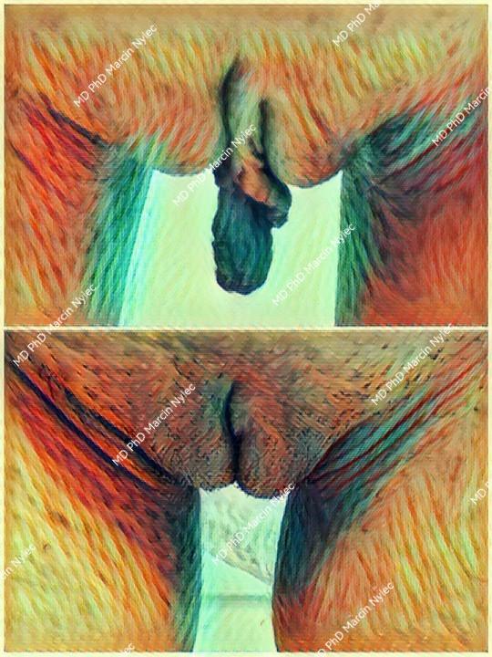Detailed labioplasty effects - before & after photos.