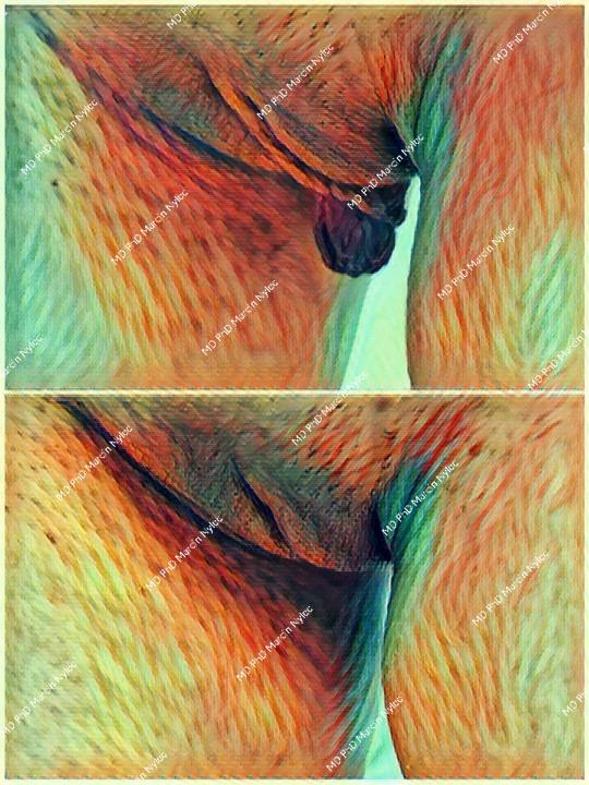 Labioplasty before & after - transformation photos.