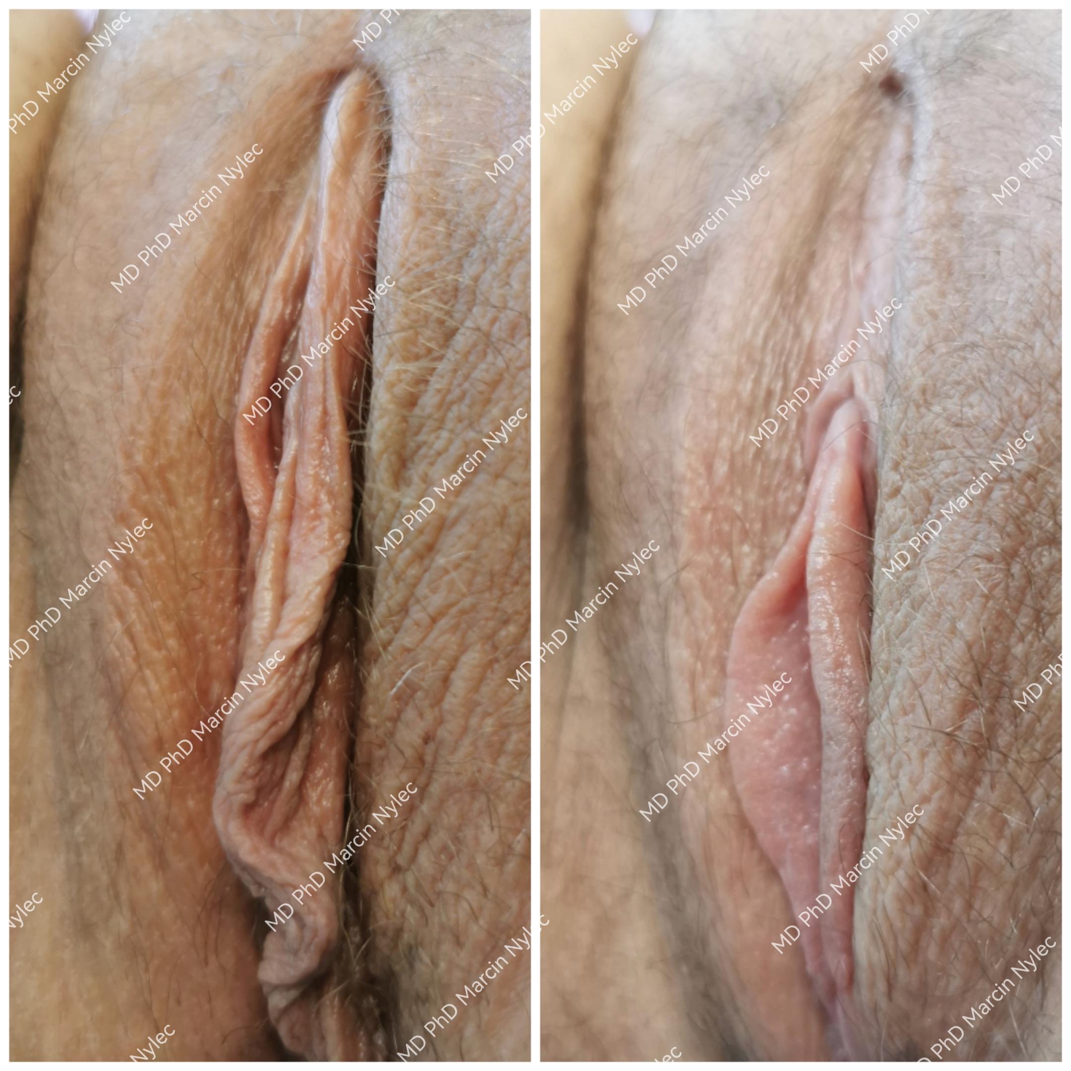 Labioplasty before & after - detailed photo results.