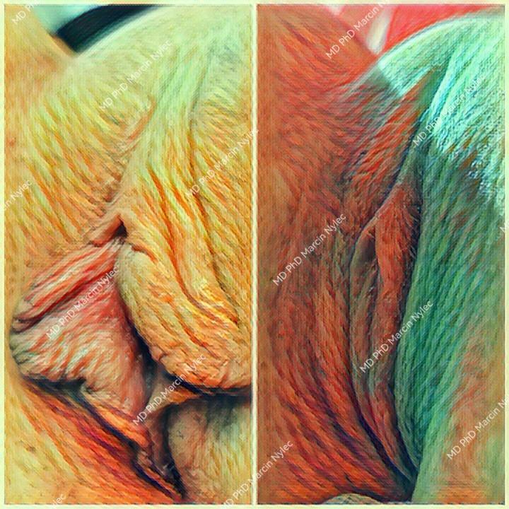 Best results of labioplasty - before and after photos.