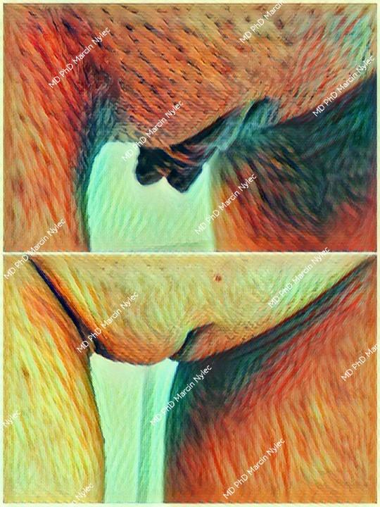 Aesthetic gynecology - labioplasty before and after surgery.