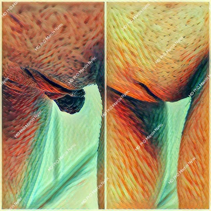 Labioplasty results - before and after aesthetic gynecology transformation.