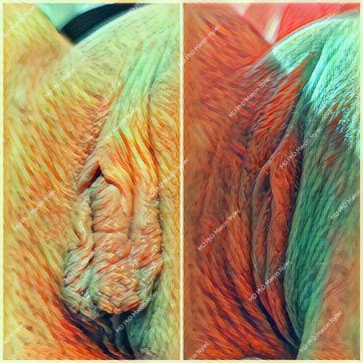 Aesthetic gynecology results - before and after labioplasty procedure.