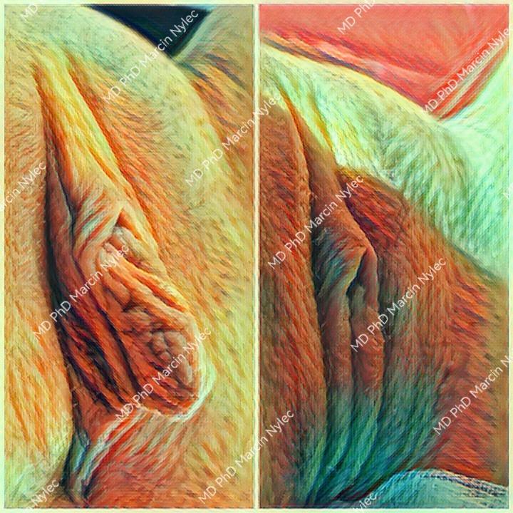 Labioplasty before and after - aesthetic gynecology surgery results.