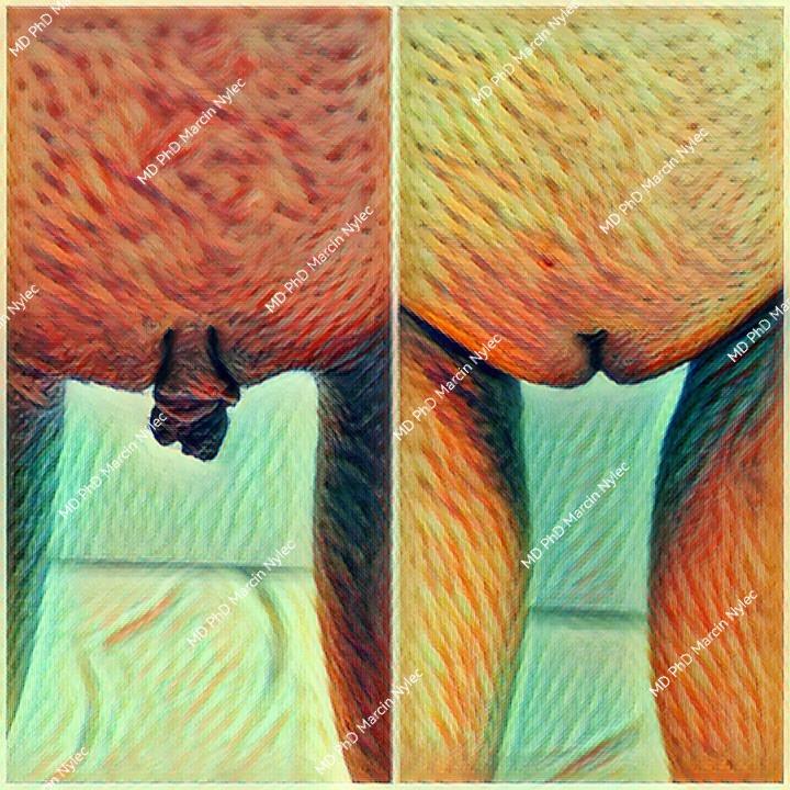 Labioplasty before & after - showing transformation results.