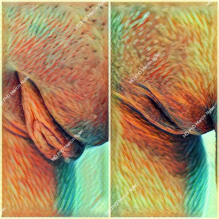 Labioplasty before and after - enhancing aesthetic gynecology outcomes.