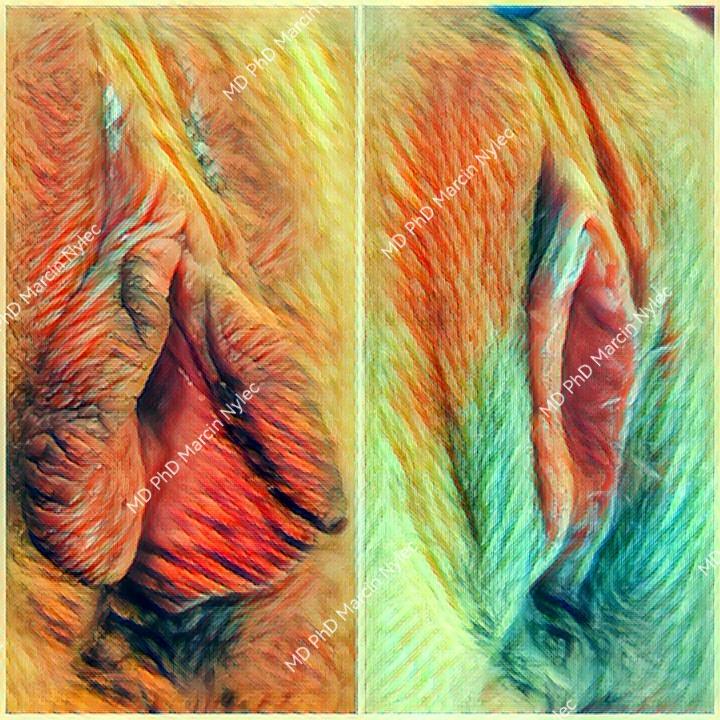 Aesthetic gynecology - labioplasty before and after transformation.
