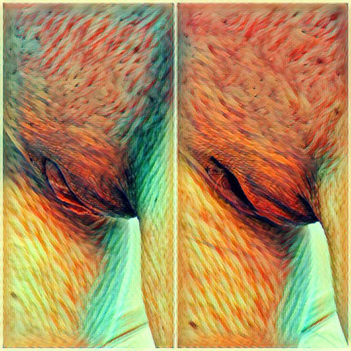 Effects of reconstruction surgery