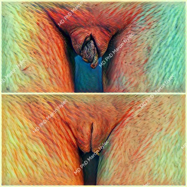Before and after labioplasty - aesthetic gynecology improvements.