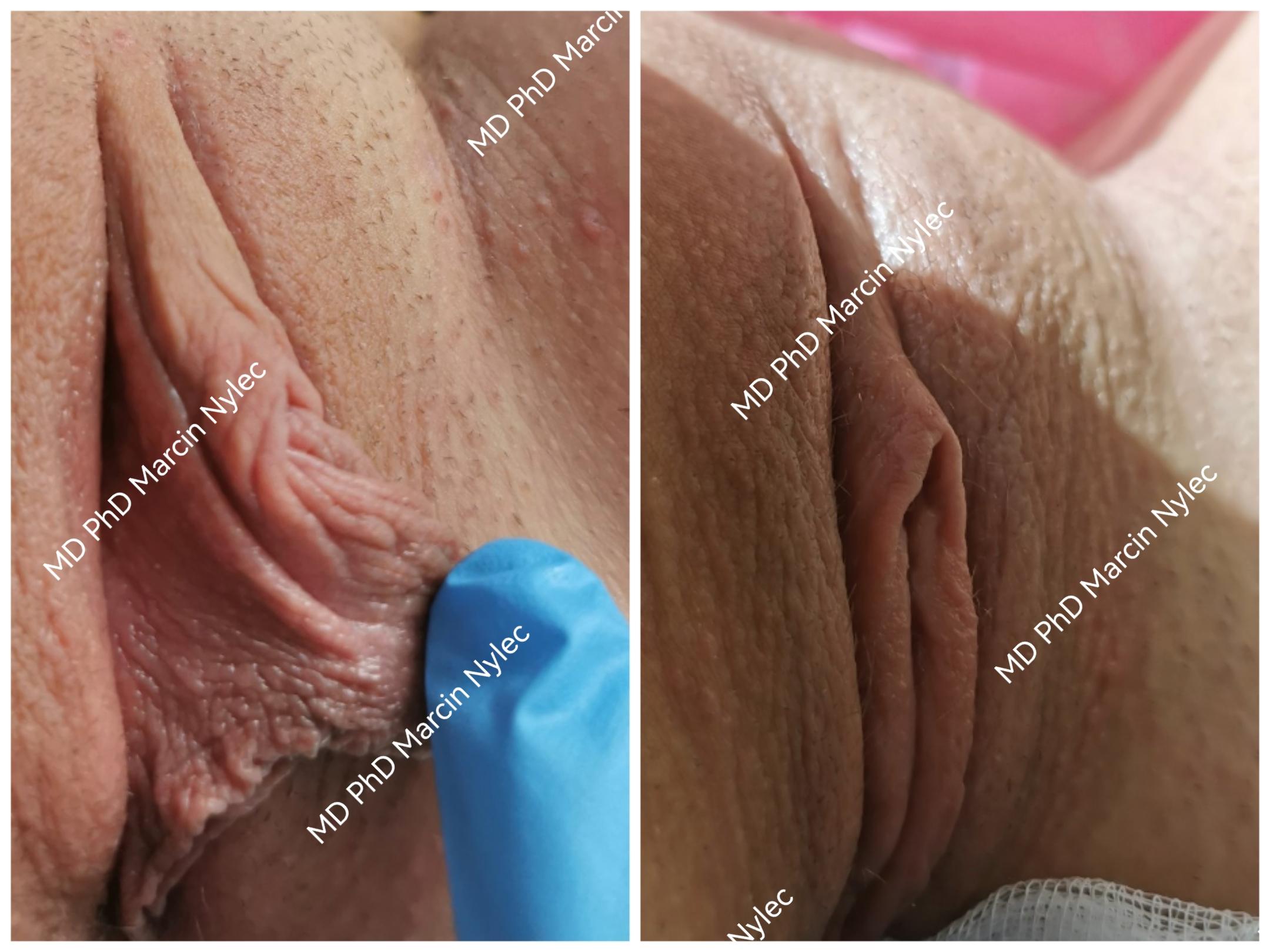 Before & After Labiaplasty Case 518 View #2