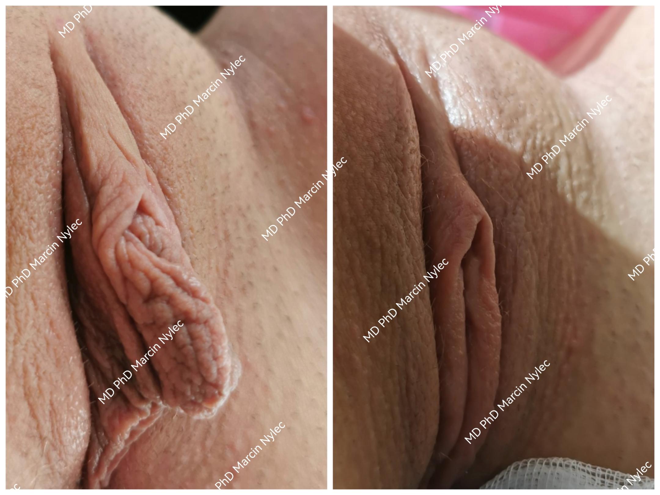 Before & After Labiaplasty Case 518 View #3