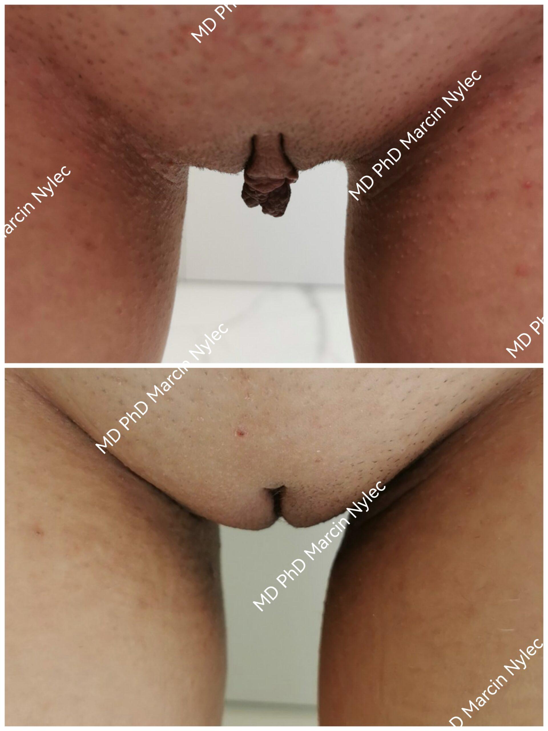 Before & After Labiaplasty Case 519 View #6