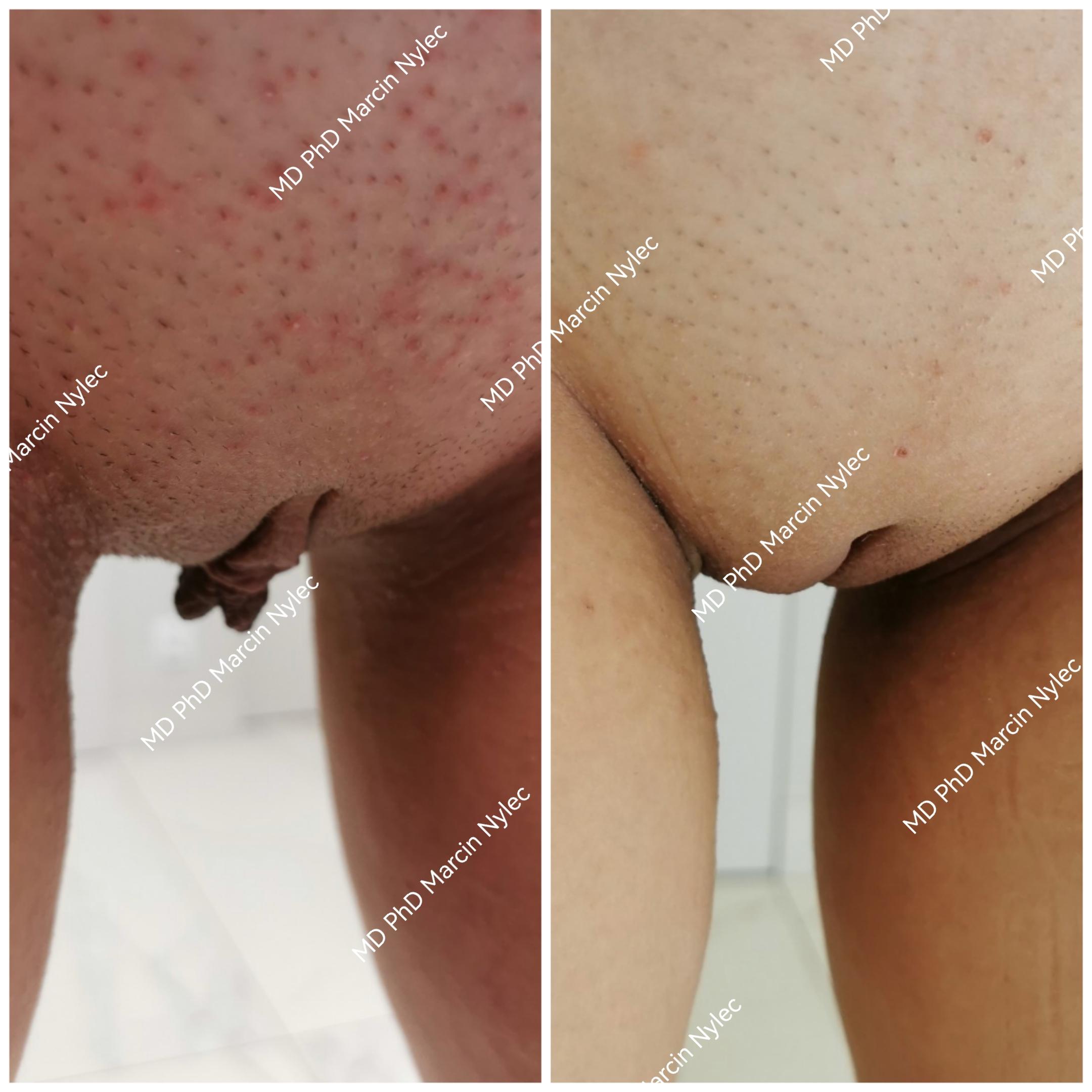 Before & After Labiaplasty Case 519 View #1