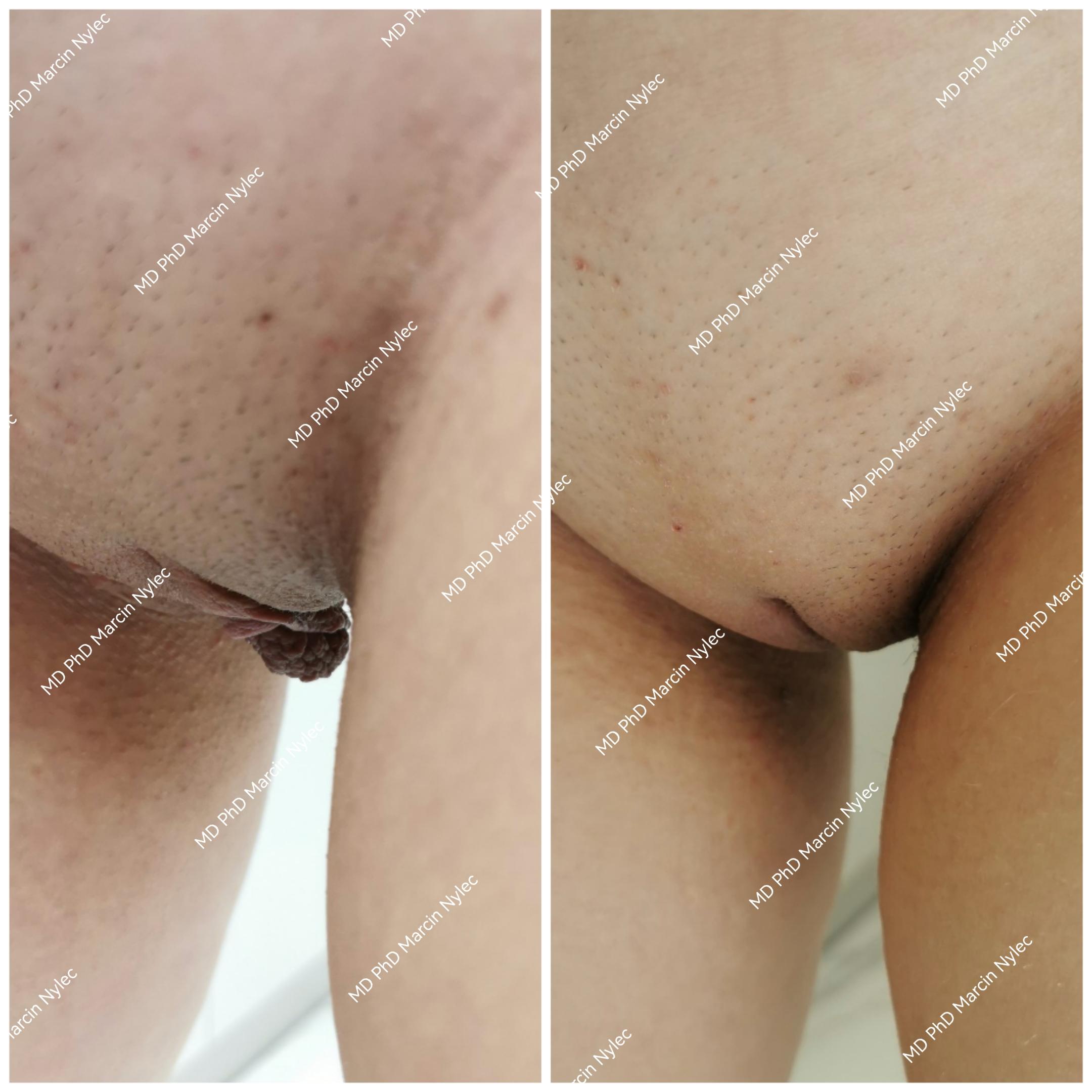 Before & After Labiaplasty Case 519 View #3