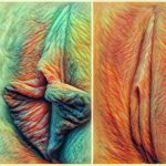 Before and after collage showing results of labiaplasty using a custom technique.