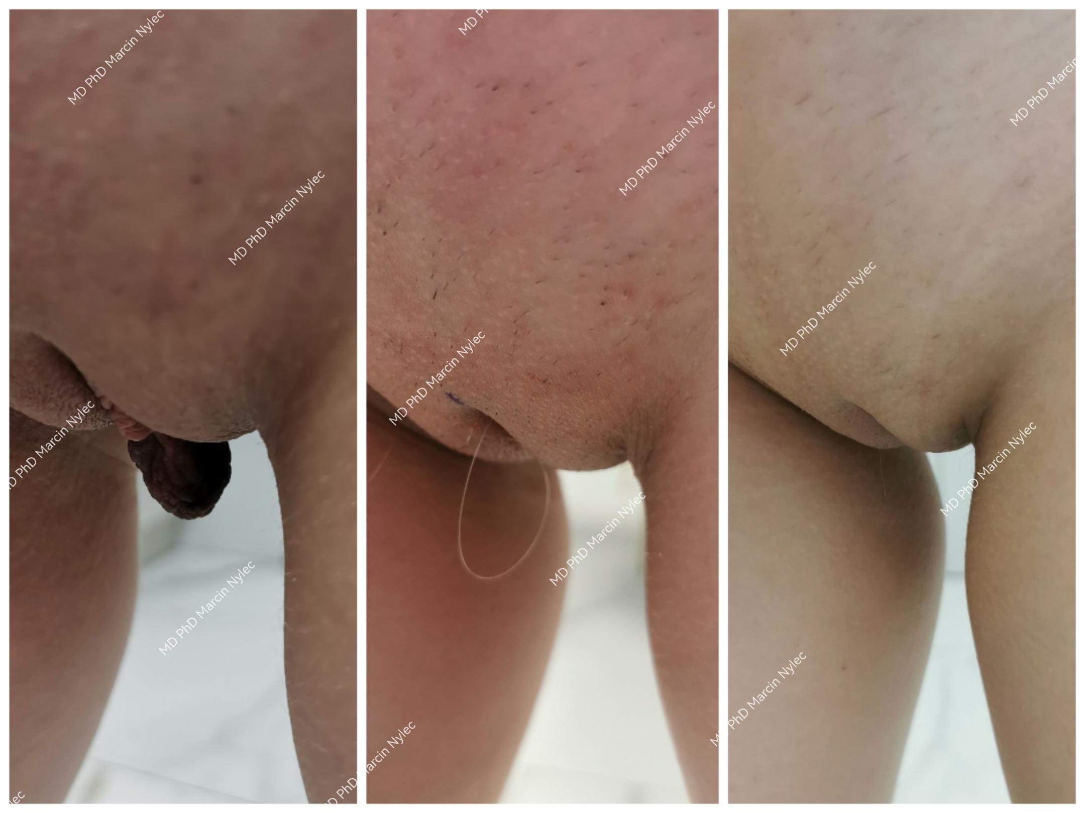 Before and after images of labiaplasty, showcasing refined labia shape.