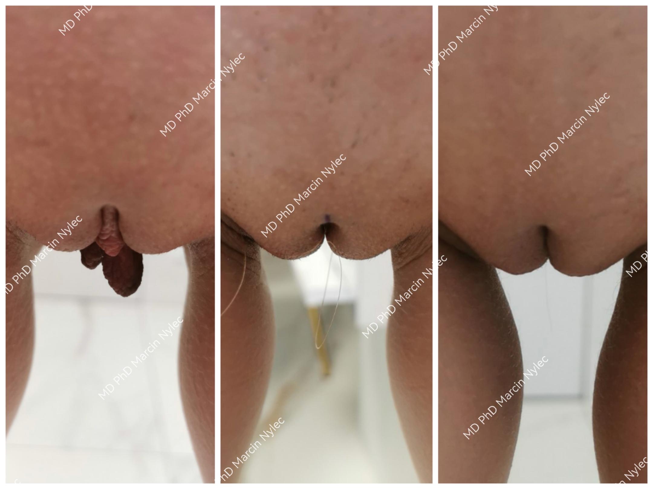 Before and after collage demonstrating labiaplasty results with a&nbsp;natural finish.