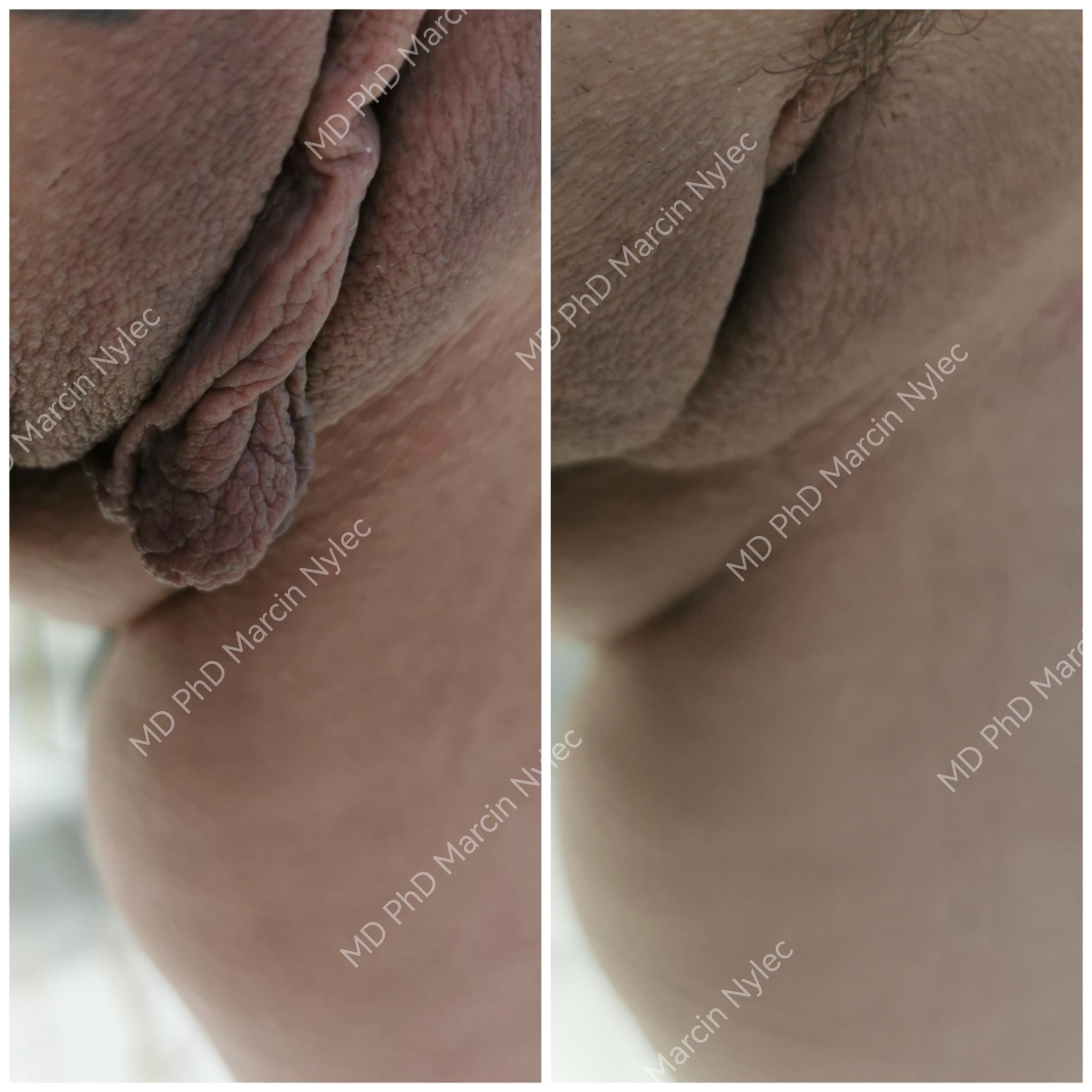 Labioplasty before & after - best effect award