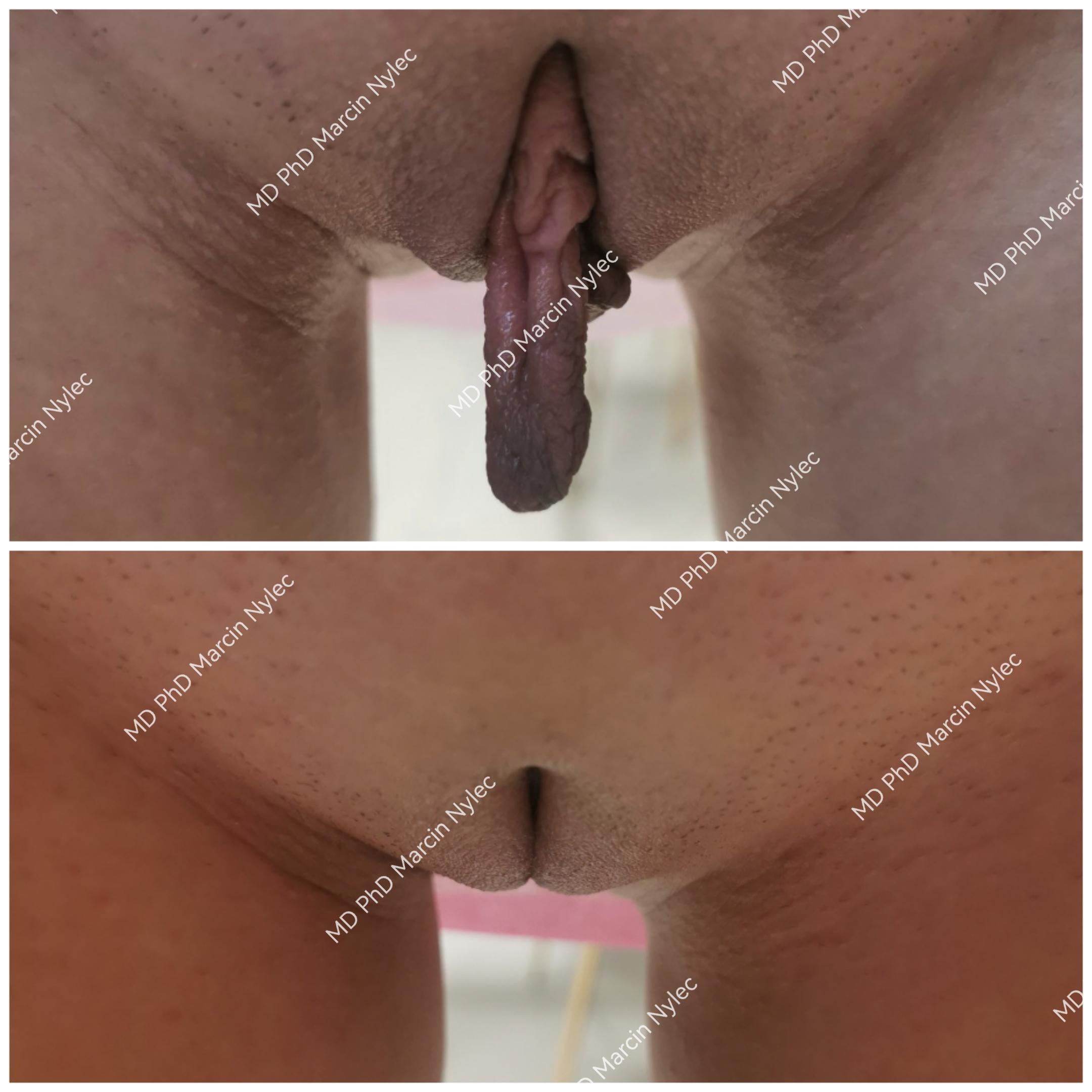 Labioplasty photos - detailed before and after.