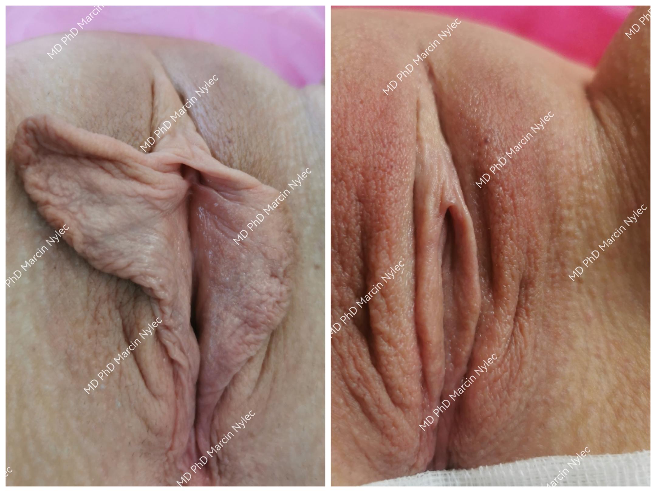 Before & after labioplasty effects - transformation images.