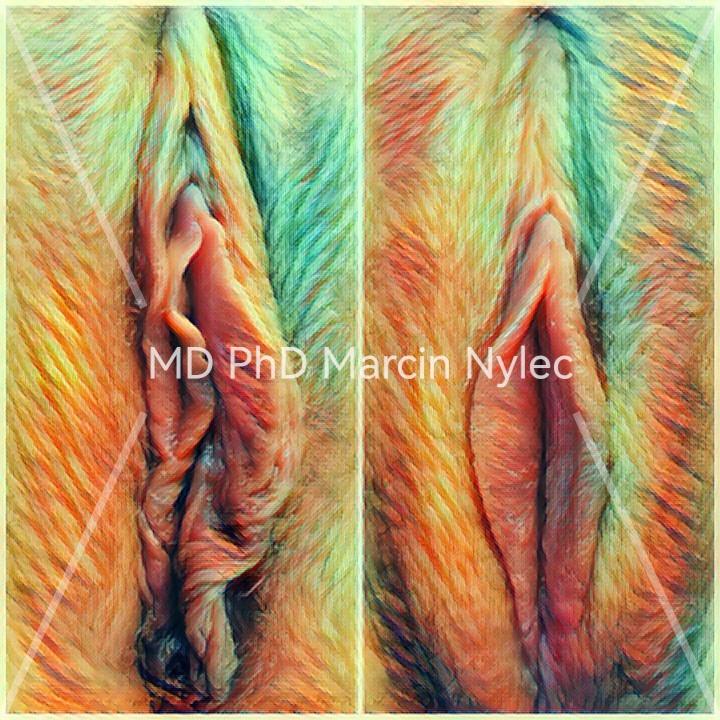 Transformation through labioplasty - before and after aesthetic gynecology.