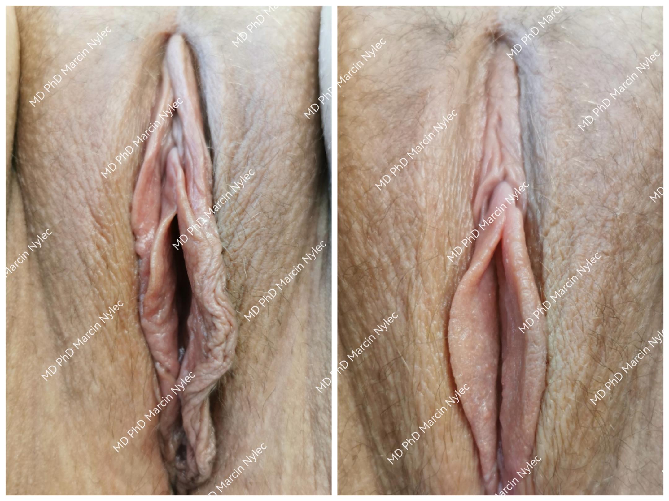 Best results of labioplasty - detailed before & after photos.
