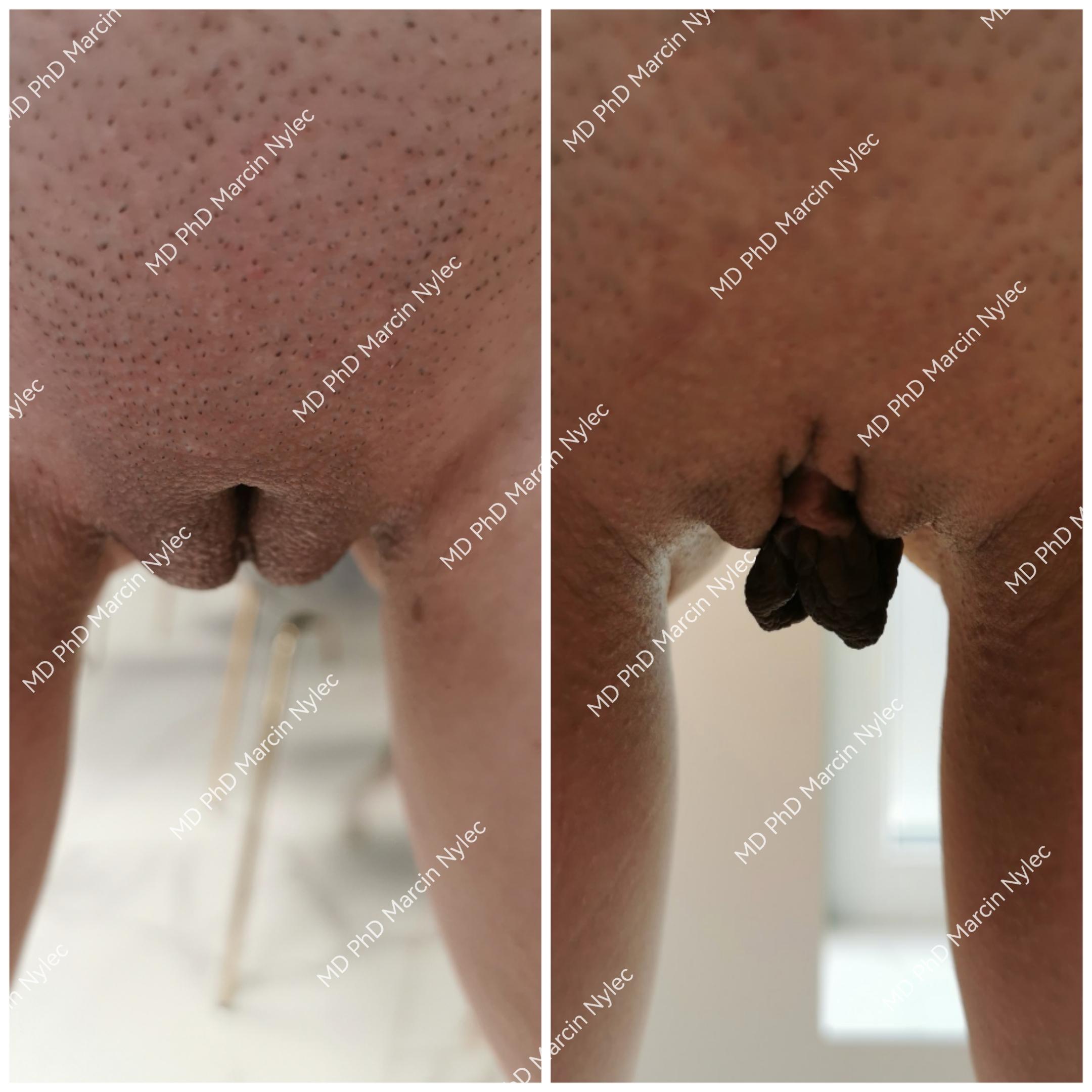 Surgical results - before and after intimate surgery.