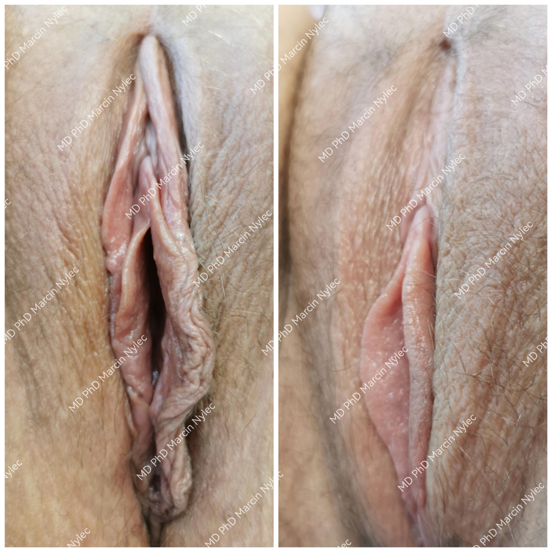 Best Labiaplasty Awards