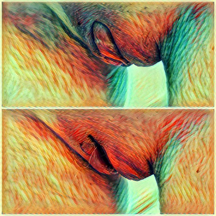 Close-up image showing a&nbsp;"micropenis" appearance resulting from labiaplasty complications, with visible deformity of the clitoral hood and labia minora.