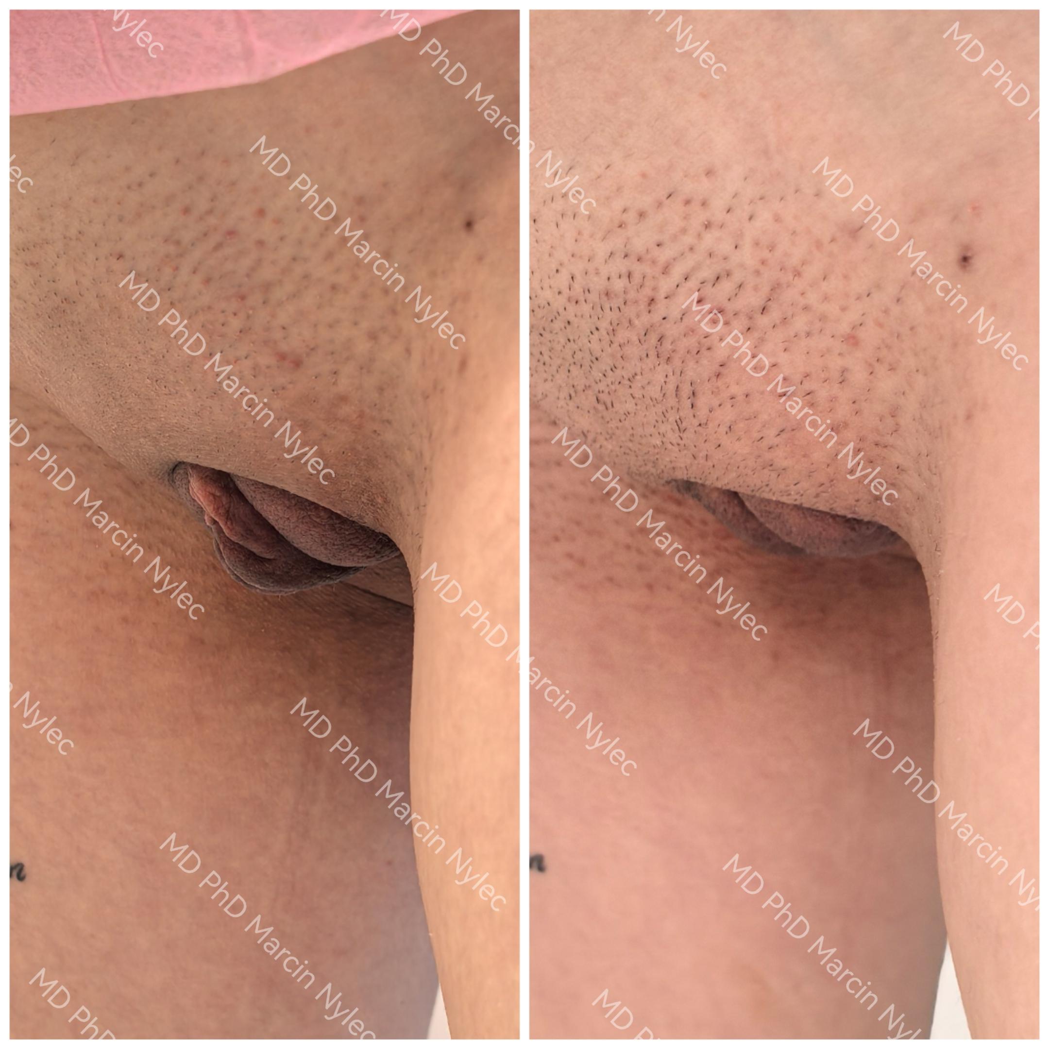 Before & After Labiaplasty Case 1002 Standing View #4