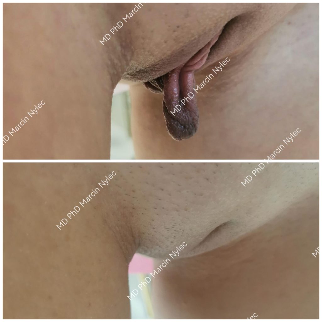 Before & After Labiaplasty Case 520 Frontal View #3