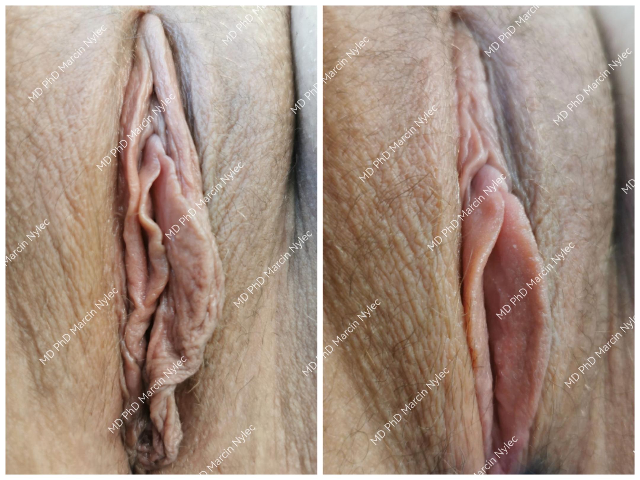 Before & After Labiaplasty Case 620 View #1