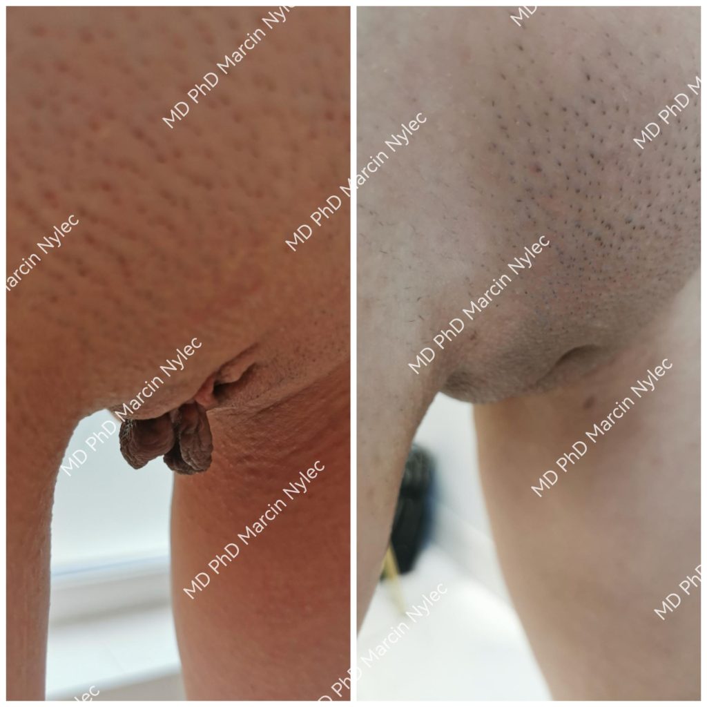 Before & After Labiaplasty Case 651View #1
