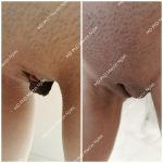 Before & After Labiaplasty Case 651View #3