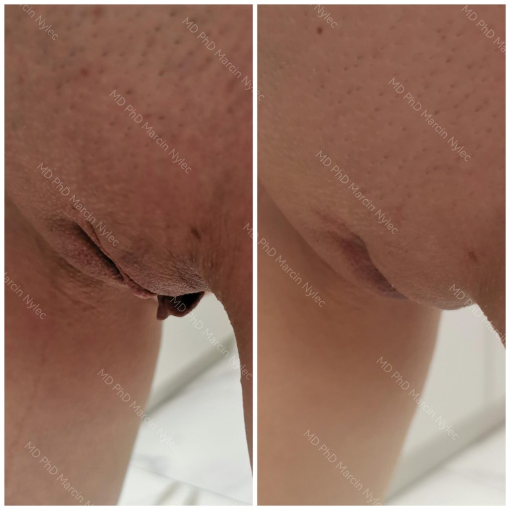 Before & After Labiaplasty Case 659 View #6