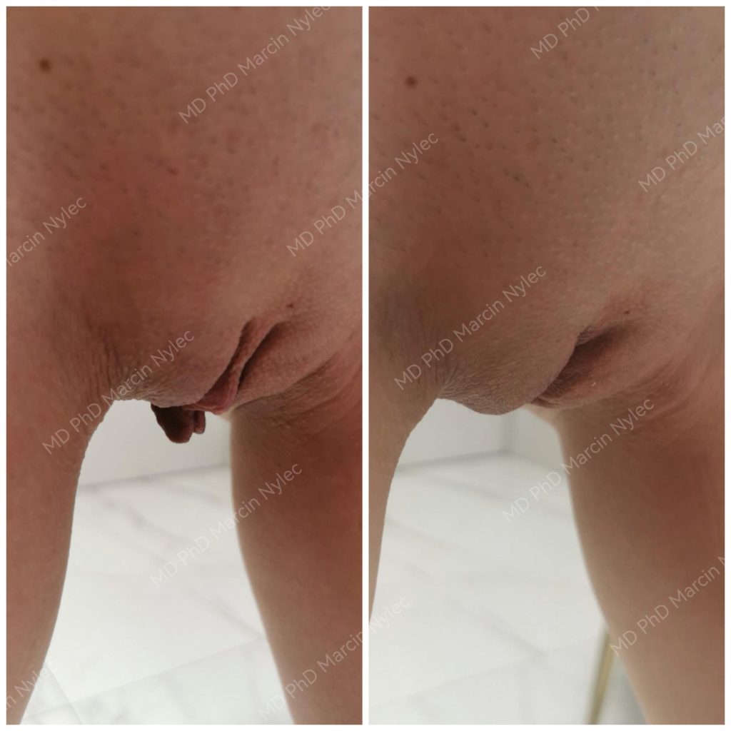 Before & After Labiaplasty Case 659 View #7
