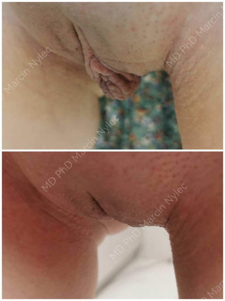 Before & After Labiaplasty Case 730 View #12