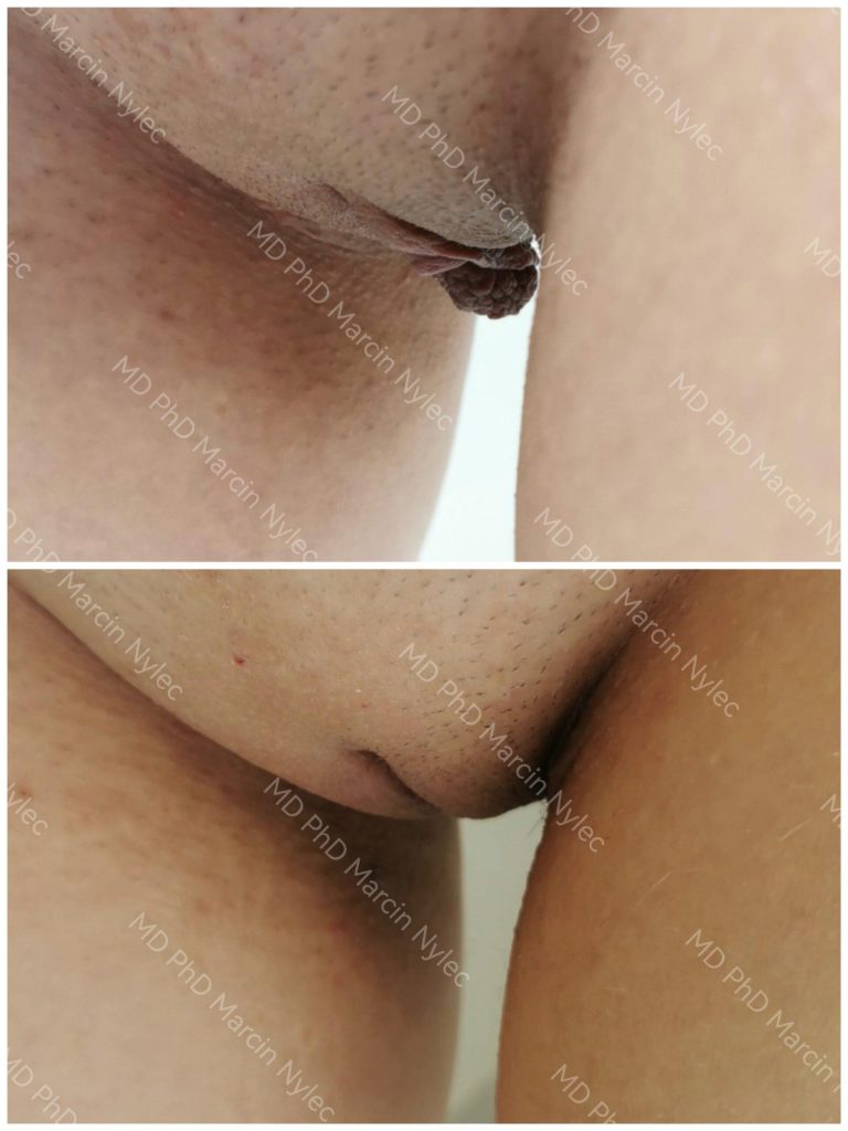 Before & After Labiaplasty Case 992 View #9