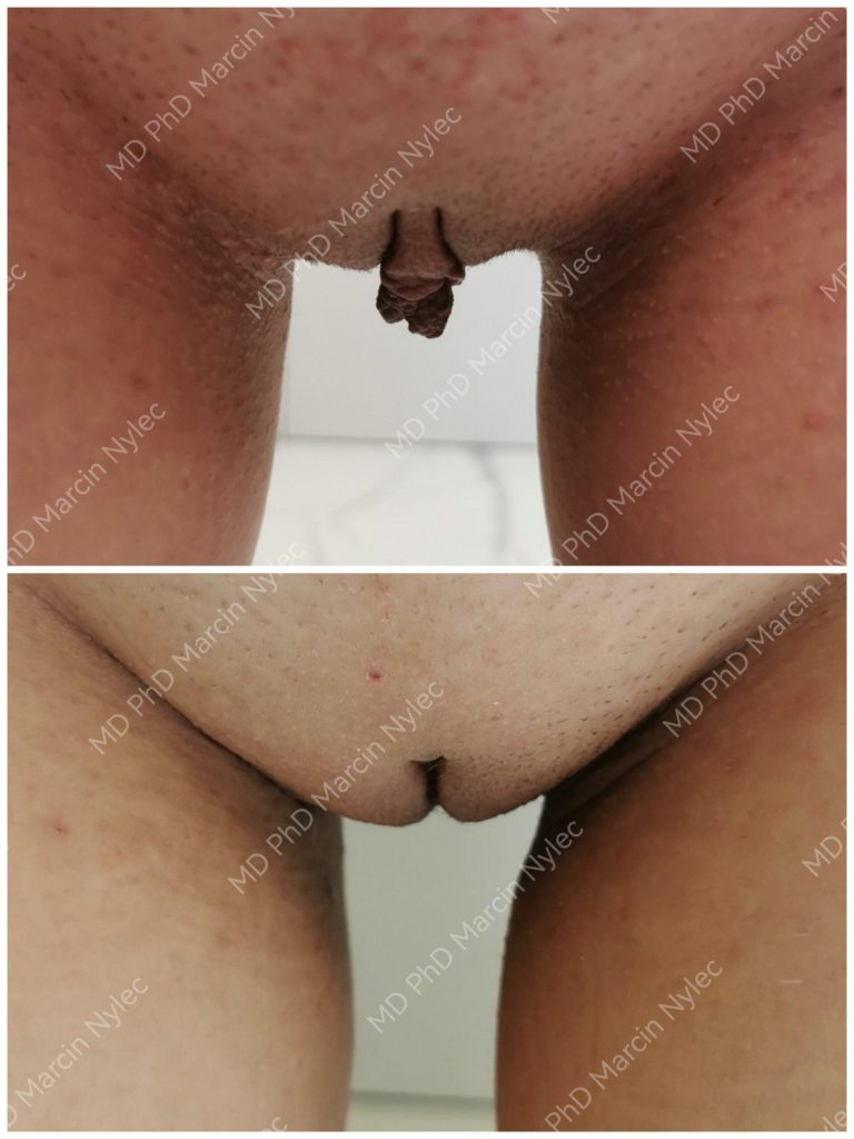 Before & After Labiaplasty Case 992 View #11