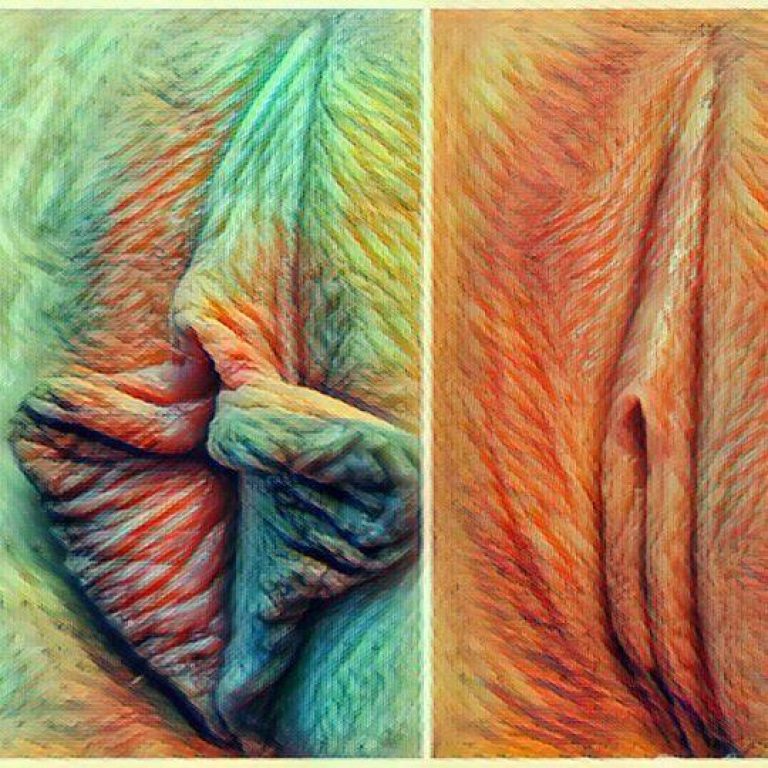 Before and after collage showing results of labiaplasty using a custom technique.